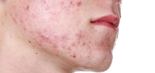 a young man's face with acne and pimples