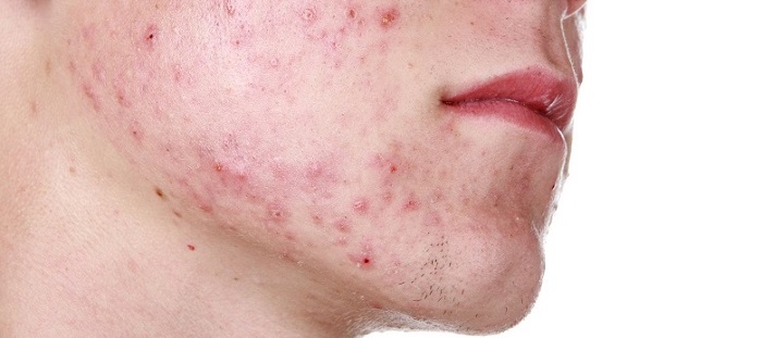 a young man's face with acne and pimples